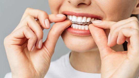 Invisalign dla mężczyzn. Uśmiechaj się swobodnie, nawet w trakcie leczenia